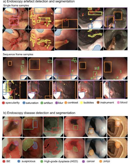 Key figure: EndoCV2020 data: artefact classes (specularity, blur, bubbles…) and disease classes (BE, HGD, cancer, polyp).