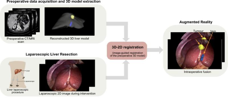 Key figure: Augmented reality in liver laparoscopy: a 3D model from preoperative CT/MRI is registered to the laparoscopic view to reveal tumour and vessels.